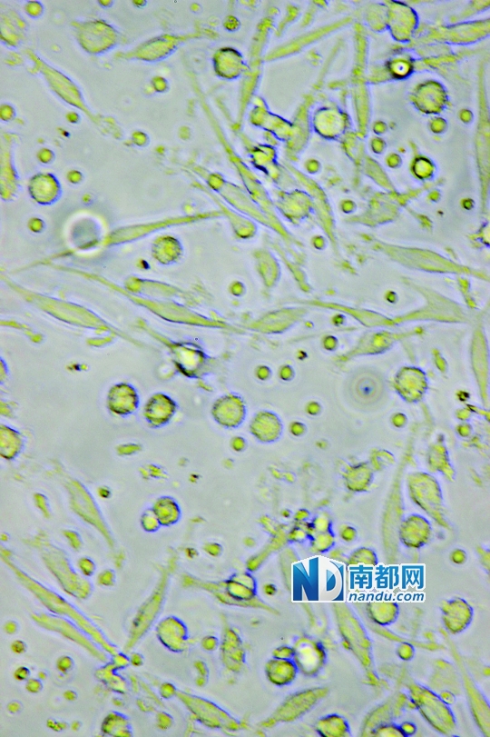 <p>    ↑目前臨床應(yīng)用最廣泛的細(xì)胞生物治療是C IK細(xì)胞治療，在顯微鏡下可清晰看到D C細(xì)胞(葉片形狀)和C IK細(xì)胞(圓點(diǎn)形狀)。</p>